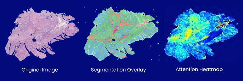 PAICON SatSight DX for Rapid MSI Detection in Colorectal Cancer
