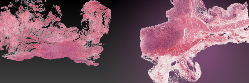 New Study: AI Reveals Hidden Subgroup in Endometrial Cancer